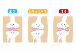 変形性膝関節症